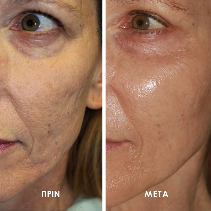 Skindose - Micro Infusion System