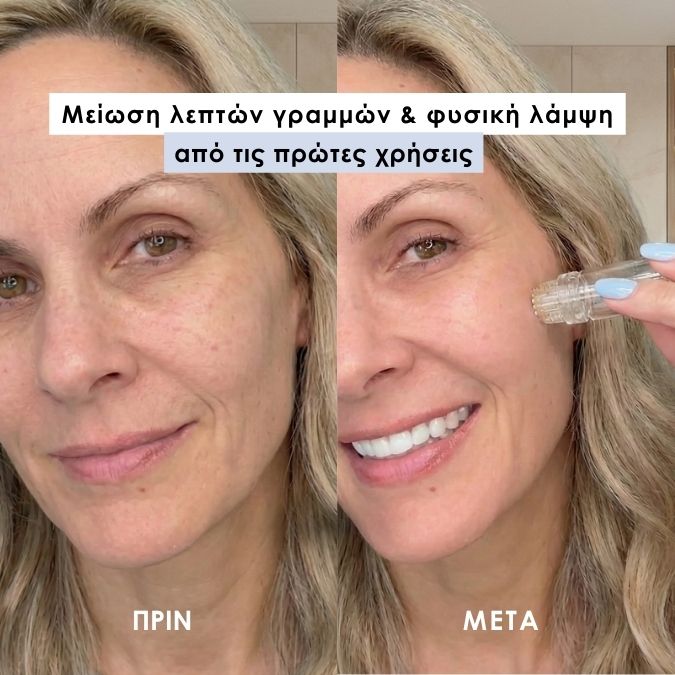 Skindose - Micro Infusion System