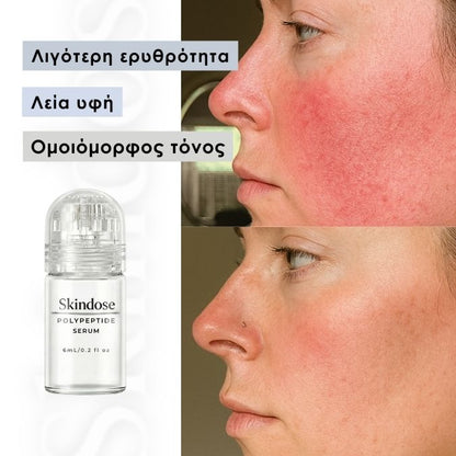 Skindose - Micro Infusion System