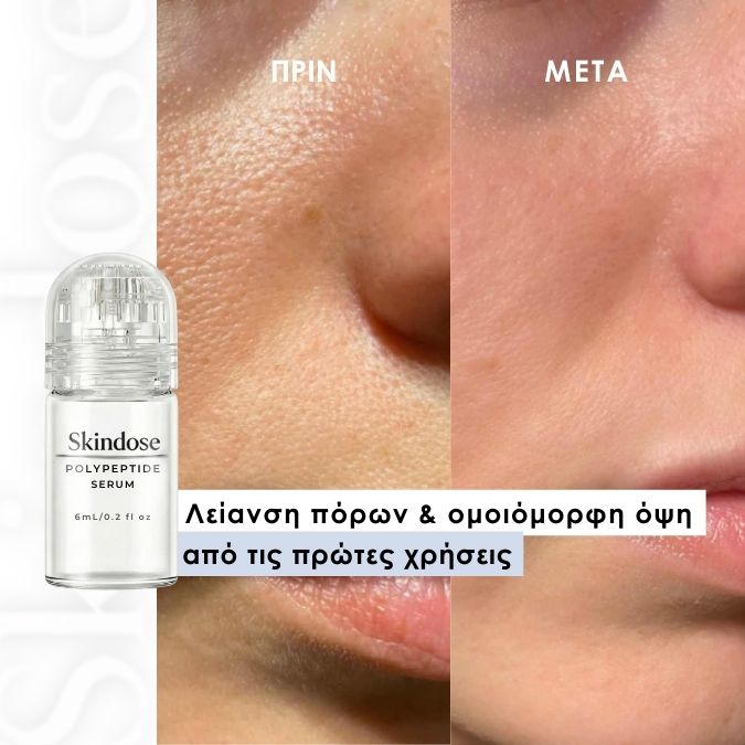 Skindose - Micro Infusion System