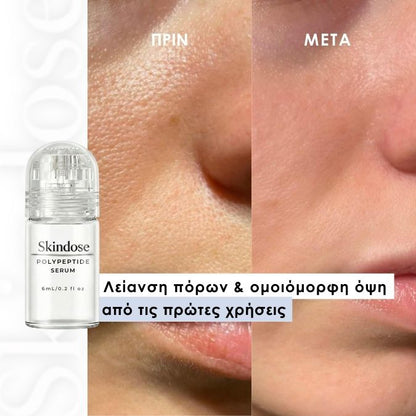 Skindose - Micro Infusion System