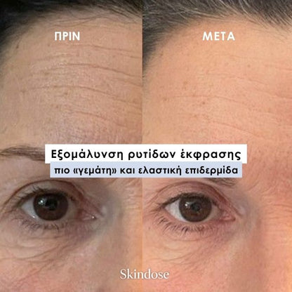 Skindose - Micro Infusion System